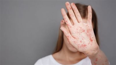 للعام الثالث على التوالي.. تجديد اعتماد مصر من منظمة الصحة العالمية كدولة خالية من الحصبة والحصبة الألمانية 