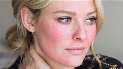  احمرار الخدود عند بعض النساء.. دليل صحة أم تحذير من مرض؟