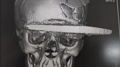 بعد إخراجه الساطور من وجه الضحية.. الفريق الطبي: الآلة الحادة دخلت الجمجمة 