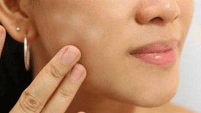 9 أسباب للإصابة بمرض نقص التصبغ لدى الفتيات.. احذريها