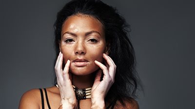 الليمون والريحان أبرزها.. حاربي البهاق بهذه الأطعمة