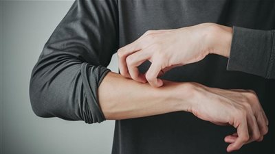 هل مرض الصدفية مُعدي ؟.. أخصائي جلدية يُجيب