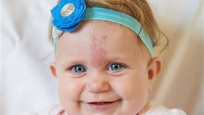 ما هي أنواع الوحمات وطرق علاجها؟.. استشاري جلدية يُجيب.. فيديو