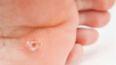 ما هو الفرق بين عين السمكة ومسمار القدم؟ 