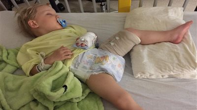 تعملي إيه لو رضيعك أصيب بكسور؟.. نصائح مهمة