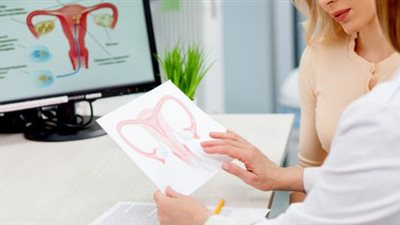 تُصاب به 75% من السيدات.. أعراض وعلاج أورام الرحم الليفية