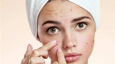 الوقاية والعلاج.. كل ما تريدين معرفته عن حب الشباب