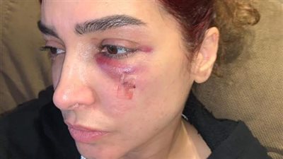 7 غرز من فعل «بنت السلطان».. آخر تطورات الحالة الصحية لـ روجينا