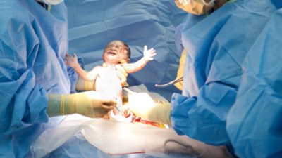 دراسة: الولادة القيصرية تُسبب أمراض خطيرة للمولودة البنت