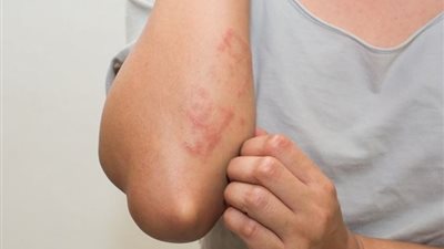 الحداد: الارتكاريا أحد أعراض ثالثة كورونا..والهندي لو وصل مصر هتبقي كارثة 