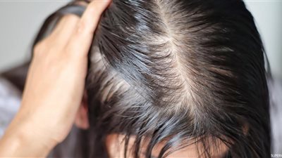 حاربي الصلع.. أطعمة منزلية تحمي شعرك من التساقط 