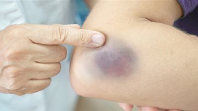 الكدمة والجلطة الدموية.. تعرفي على الفرق بينهما