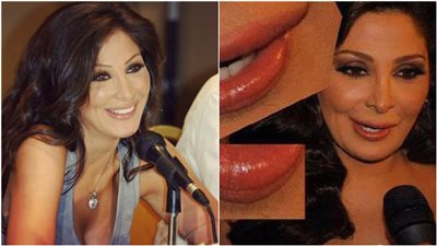 آخرهن إليسا.. فنانات تعرضن لأزمات من عمليات التجميل