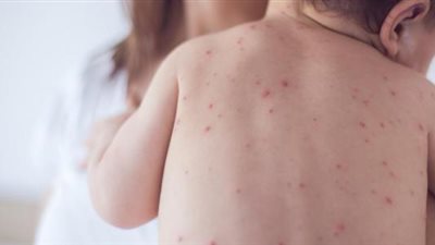 الصحة: لم نرصد أي حالات مصابة بالحصبة بين الأطفال 