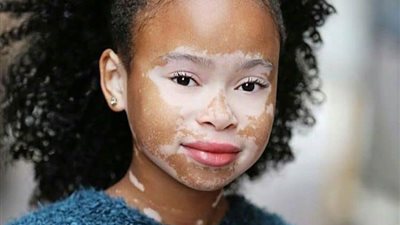 يبدأ في اليدين أولاً ثم الوجه.. استشاري أمراض جلدية تكشف 5 معلومات عن مرض البهاق| فيديو