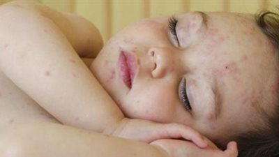 علاج «حمو النيل» في المنزل.. 5 طرق سهلة منها الاستحمام بالماء البارد