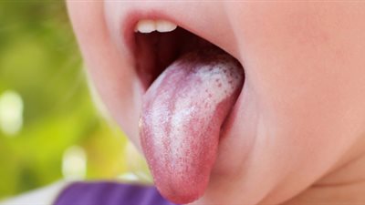 علاج فطريات الفم للرضع في المنزل بطريقة سهلة