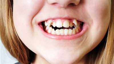 «أسنان الحكمة».. تعرفي على الممنوع والمسموح بعد خلع «ضرس العقل»