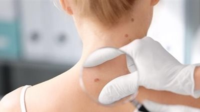 نوع بشرتك.. 5 أشياء تزيد من احتمالية إصابتك بسرطان الجلد