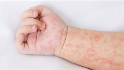 تعرفي عليها.. أعراض إصابة طفلك بالحمى الوردية