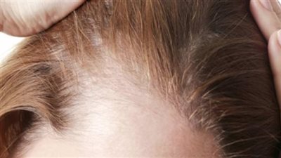 ثعلبة الشعر.. الأعراض وطرق العلاج والفئة الأكثر إصابة بالمرض