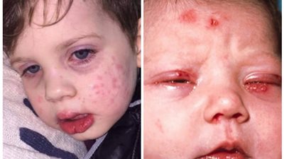 احذري تقبيل صغيرك.. كيف ينتقل فيروس الهربس لحديثي الولادة والبالغين؟