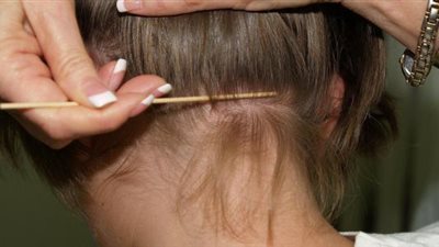 بعيداً عن الأدوية.. 5 وصفات طبيعية للتخلص من القمل في يوم واحد