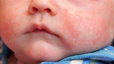 الإكزيما.. مرض جلدي يُصيب الأطفال وليس له علاج