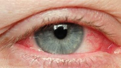 تعرفي على أسباب الإصابة بالتهاب الملتحمة وطرق علاج العين الوردية