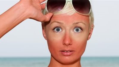إلى متى تستمر حروق الشمس وطرق تسريع عملية الشفاء؟