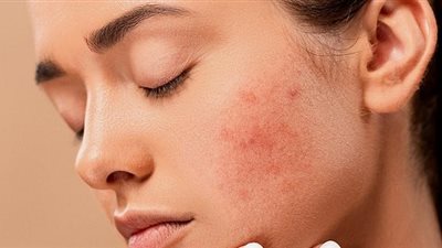 تعرفي على أهم أسباب حدوث كلف البشرة وخطورته