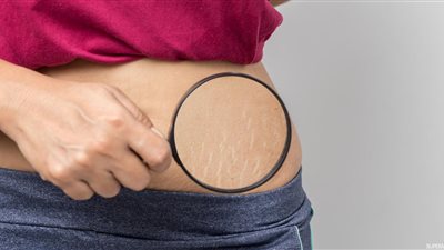 تخلصي من علامات تمدد الجلد بعد الولادة بـ 5 وصفات طبيعية