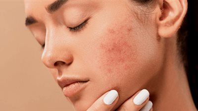 تعرفي على طرق الوقاية منها.. 5 أمراض جلدية تُصيب النساء أكثر من الرجال