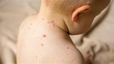  تزامنًا مع الدراسة.. أعراض وأسباب إصابة الأطفال بالجدري المائي 