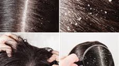 تزداد في فصل الشتاء.. 7 نصائح لشعر بدون قشرة 