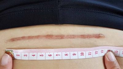 كارثة طبية.. ما هي أضرار الولادة القيصرية؟