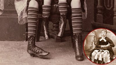 «ميرتل كوربين».. الفتاة الوحش ذات الأرجل الأربعة ورحمين و5 أطفال