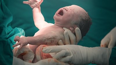 أيهما أفضل البنج النصفي أو الكلي في الولادة القيصرية؟.. طبيب نساء يجيب