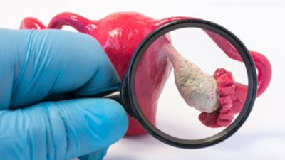 اهربي من رعب «تكيسات المبايض» والعقم.. الأعراض والعلاج بالتفصيل