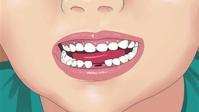 «بعد خلع الضرس» اعرفي المدة المناسبة للامتناع عن تناول الطعام