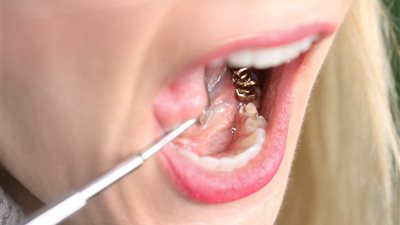 حكم المضمضة في الوضوء مع تركيب الأسنان من الذهب والفضة.. «الإفتاء» تُجيب