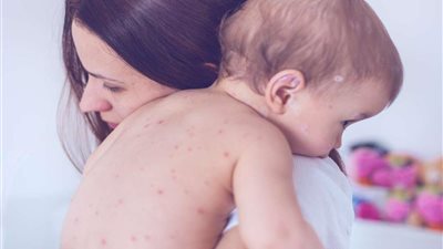 بلاش حمامات عامة.. نصائح للأم لحماية أطفالها من جدري القرود