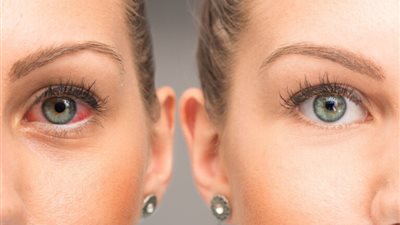 ارتفاع ضغط العين.. أعراض تدل على الإصابة بمرض المياه الزرقاء