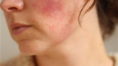 التصبغات.. أبرز مشاكل الجلد بسبب الشمس الحارقة وطرق طبيعية لعلاجها