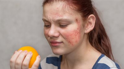 رد فعل مناعي.. كل ما تريدين معرفته عن حساسية الطعام 