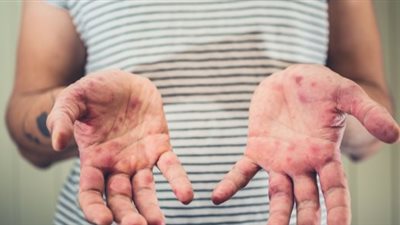 ابتعدي عن اللعاب.. احمي نفسك من عدوى الحمى القلاعية بتلك الطرق