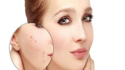 أفضل طريقة للتخلص من ندبات حب الشباب