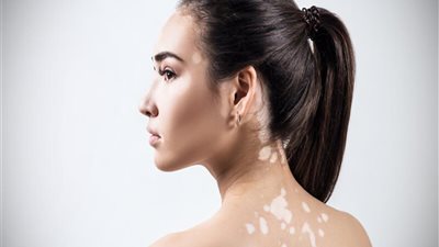 كريم سحري يُعالج البهاق في أيام.. تعرفي على طريقة استخدامه