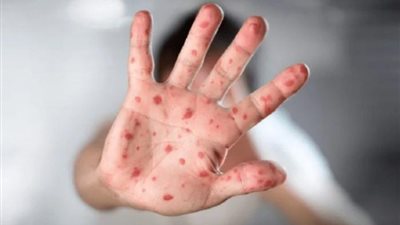 بعد إعلان حالة الطوارئ.. طرق فعالة لحماية أطفالك من جدري القرود