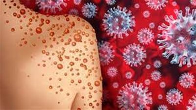 استشاري يكشف لـ«هير نيوز» مدى خطورة «جدري القرود»